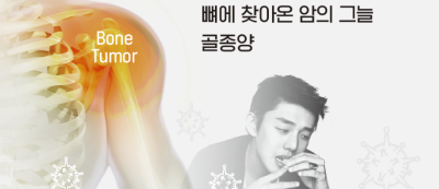 뼈에 찾아온 암의 그늘 골종양 - 배우 유아인과 골종양