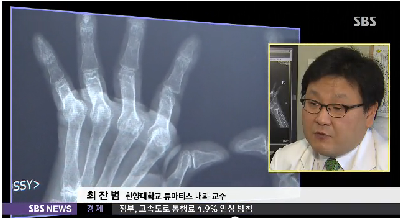 [sbs나이트라인]류마티스, 늦은 진단이 병 키운다…"의심 증상 체크하세요"
