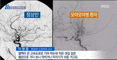 [뉴스데스크]강도는 피했지만...모야모야병 여대생 의식불명
