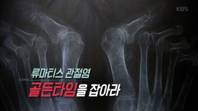 [박광식의 건강365] 류마티스관절염, 찜질보단 ‘운동’이 효과