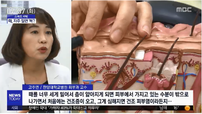 [뉴스투데이]하얀 때까지 벗겨 내면 피부 염증 생겨요