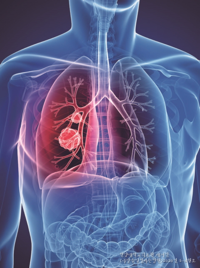 폐암의 치료와 조기 검진의 중요성